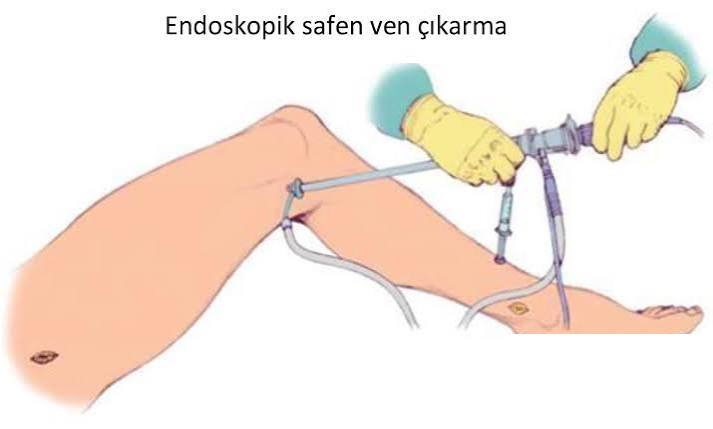 Endoskopik Safen Çıkarma Sistemi